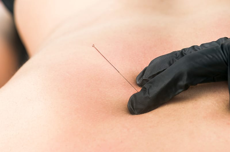 Patiënt heeft dry needling bij terugkerende spierklachten en wordt geholpen door een fysiotherapeut